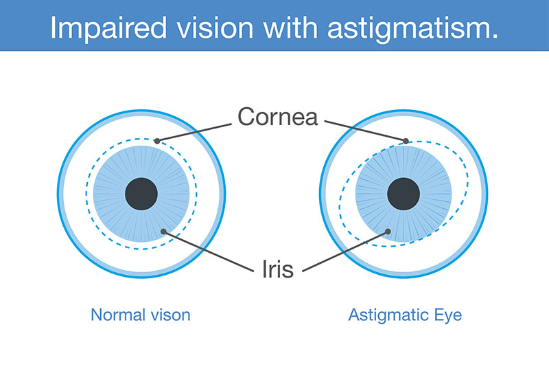 what astigmatism looks like