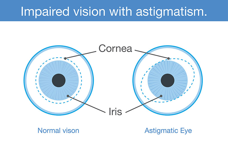 astigmatism-q-a-symptoms-causes-treatment