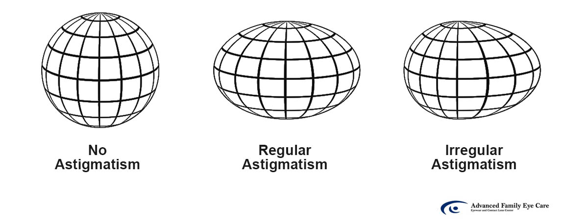 Astigmatism Eye Shape