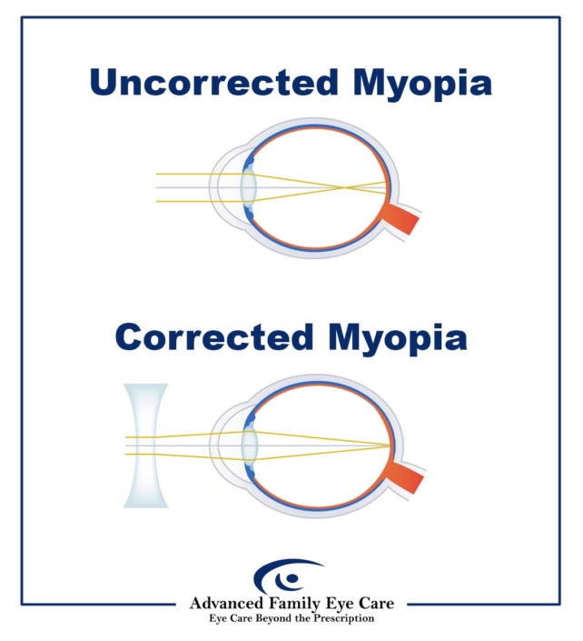 Myopia (Nearsightedness) Q&A | Advanced Family Eye Care