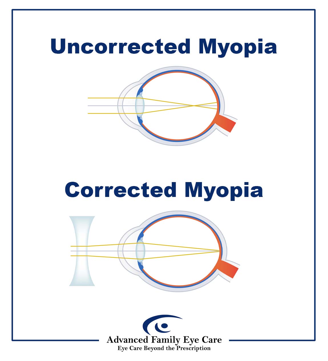 Infographic illustrating myopia correction with eyeglass or contact lenses. Diagram 1 shows an untreated myopic eye, where light enters and is bent before the retina, causing blurred vision. Diagram 2 shows myopia corrected with a concave lens. The concave lens bends light prior to entering the cornea, counteracting the misshaped eye, allowing light to focus on the retina for a clear distant image.