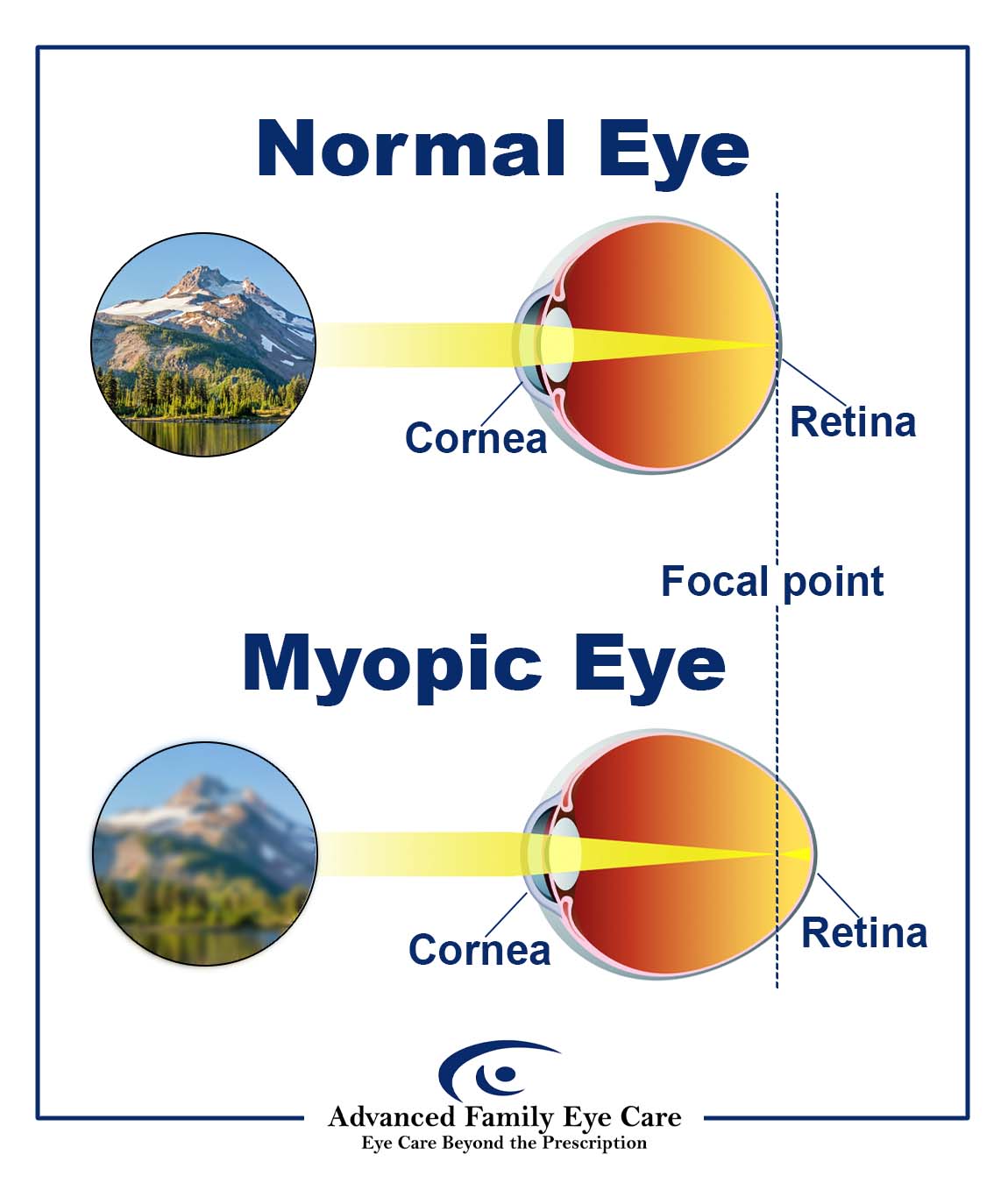 Infographic of two diagrams, the first one illustrating a normal eye and the second one illustrating an eye with myopia. The first diagram shows a normally shaped eye on the right side of the diagram. Light enters the eye and is refracted onto the retina. The left side of the diagram shows what this eye sees – a clear image of mountains. The second diagram shows an abnormally shaped myopic eye on the right side. Light enters the eye and is refracted in front of the retina. The left side of diagram 2 shows what this eye sees – a blurry image of mountains.